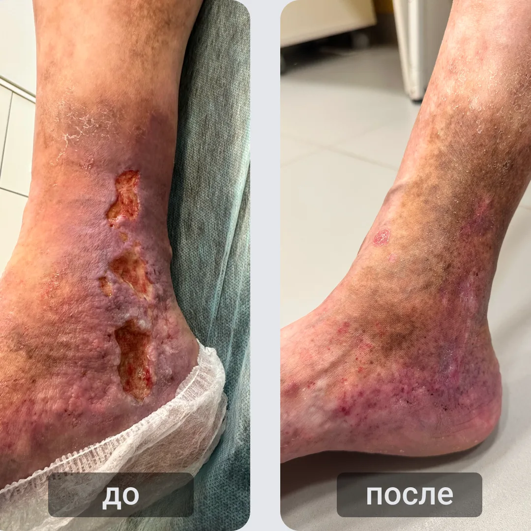 До и после лечения трофической язвы